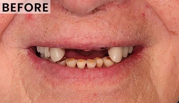 Before — implant bridge