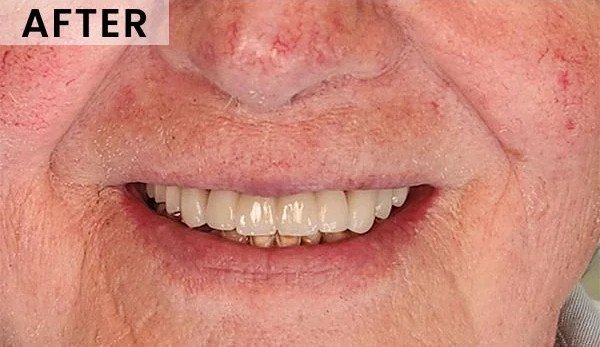 After — implant bridge